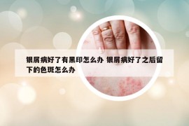 银屑病好了有黑印怎么办 银屑病好了之后留下的色斑怎么办