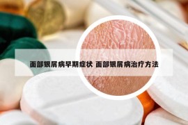 面部银屑病早期症状 面部银屑病治疗方法