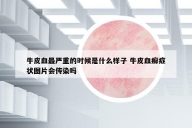 牛皮血最严重的时候是什么样子 牛皮血癣症状图片会传染吗