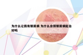 为什么让我有银屑病 为什么会得银屑病能治好吗