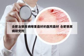 合肥治银屑病哪里最好的医院最好 合肥银屑病研究院