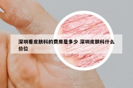 深圳看皮肤科的费用是多少 深圳皮肤科什么价位