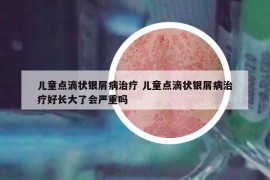 儿童点滴状银屑病治疗 儿童点滴状银屑病治疗好长大了会严重吗