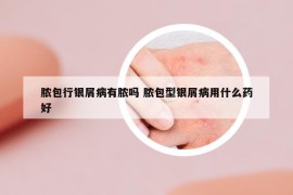 脓包行银屑病有脓吗 脓包型银屑病用什么药好