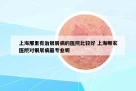 上海那里有治银屑病的医院比较好 上海哪家医院对银屑病最专业呢