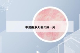 牛皮癣多久会长成一片