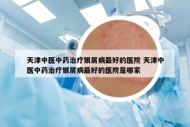 天津中医中药治疗银屑病最好的医院 天津中医中药治疗银屑病最好的医院是哪家