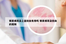 银屑病耳朵上面放血有用吗 银屑病耳朵放血的视频