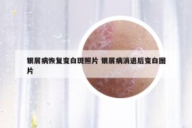 银屑病恢复变白斑照片 银屑病消退后变白图片