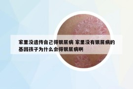 家里没遗传自己得银屑病 家里没有银屑病的基因孩子为什么会得银屑病啊