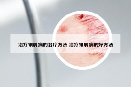 治疗银屑病的治疗方法 治疗银屑病的好方法