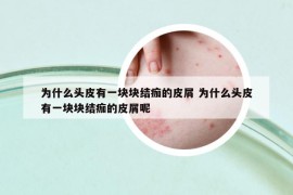 为什么头皮有一块块结痂的皮屑 为什么头皮有一块块结痂的皮屑呢