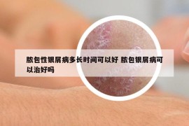 脓包性银屑病多长时间可以好 脓包银屑病可以治好吗