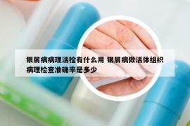 银屑病病理活检有什么用 银屑病做活体组织病理检查准确率是多少