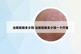 治银屑癣多少钱 治银屑癣多少钱一个疗程