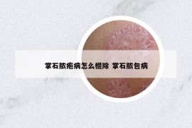 掌石脓疱病怎么棍除 掌石脓包病