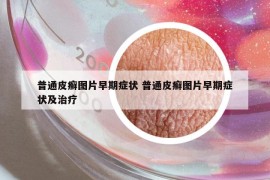 普通皮癣图片早期症状 普通皮癣图片早期症状及治疗