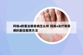 阿维a胶囊治银屑病怎么样 阿维a治疗银屑病的最佳服用方法