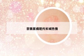 京银屑病现代长城热情