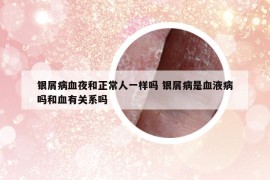 银屑病血夜和正常人一样吗 银屑病是血液病吗和血有关系吗