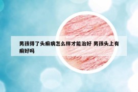 男孩得了头癣病怎么样才能治好 男孩头上有癣好吗