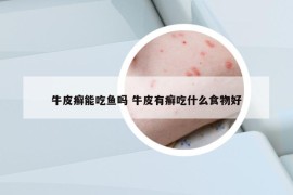 牛皮癣能吃鱼吗 牛皮有癣吃什么食物好