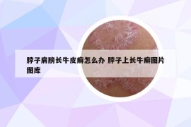 脖子肩膀长牛皮癣怎么办 脖子上长牛癣图片图库