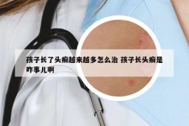 孩子长了头癣越来越多怎么治 孩子长头癣是咋事儿啊