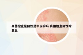 真菌检查是阴性是牛皮癣吗 真菌检查阴性啥意思