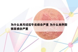 为什么来月经后牛皮癣会严重 为什么来例假银屑病会严重