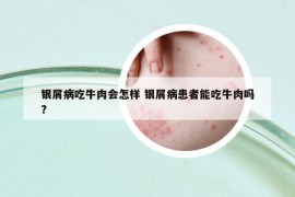 银屑病吃牛肉会怎样 银屑病患者能吃牛肉吗?