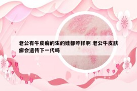 老公有牛皮癣的生的娃都咋样啊 老公牛皮肤癣会遗传下一代吗