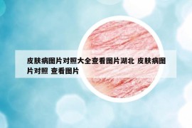 皮肤病图片对照大全查看图片湖北 皮肤病图片对照 查看图片