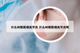 什么叫银屑病关节炎 什么叫银屑病关节炎呢