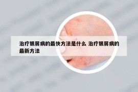 治疗银屑病的最快方法是什么 治疗银屑病的最新方法