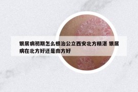 银屑病初期怎么根治公立西安北方精湛 银屑病在北方好还是南方好