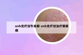 uvb光疗仪牛皮癣 uvb光疗仪治疗银屑病