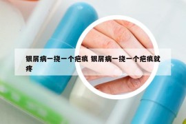 银屑病一挠一个疤痕 银屑病一挠一个疤痕就疼