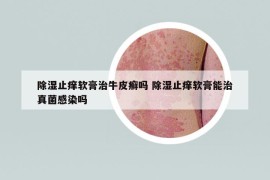 除湿止痒软膏治牛皮癣吗 除湿止痒软膏能治真菌感染吗