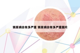 银屑病会有多严重 银屑病会有多严重图片