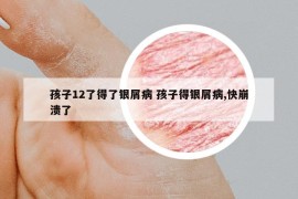 孩子12了得了银屑病 孩子得银屑病,快崩溃了