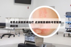 寻常点滴银屑病治疗 点滴银屑病和寻常银屑病区别