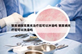 银屑病做完黑光治疗后可以冲澡吗 银屑病光疗后可以洗澡吗