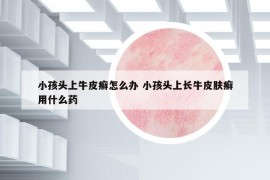 小孩头上牛皮癣怎么办 小孩头上长牛皮肤癣用什么药