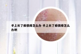 手上长了癣很痒怎么办 手上长了癣很痒怎么办啊