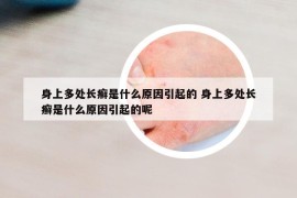 身上多处长癣是什么原因引起的 身上多处长癣是什么原因引起的呢