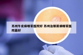 苏州牛皮癣哪家医院好 苏州治银屑病哪家医院最好