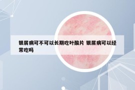 银屑病可不可以长期吃叶酸片 银屑病可以经常吃吗