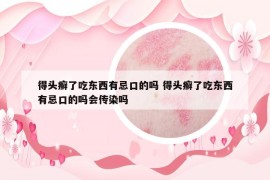 得头癣了吃东西有忌口的吗 得头癣了吃东西有忌口的吗会传染吗