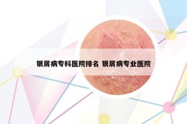 银屑病专科医院排名 银屑病专业医院